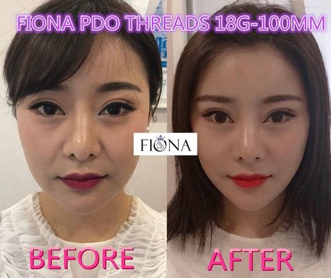 Fiona PDO en PCL-Draad, 38mm de Draad van de Gezichtslift PDO