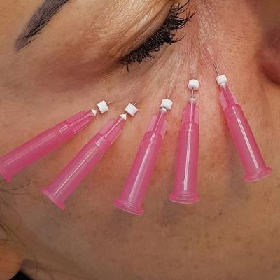 Onder van de Vosogen PDO van de Oogverjonging de Draadlift